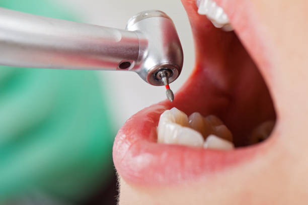 Best Knocked-Out Tooth (Avulsed Tooth) Treatment in Glenside, PA